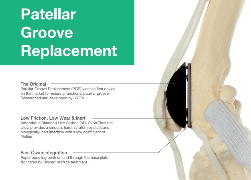Kyon PGR Patellar Groove Replacement Starter Kit